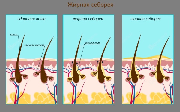 Себорейный дерматит на лице. Фото, причины и лечение народными средствами, мази и кремы, препараты, лечебные шампуни