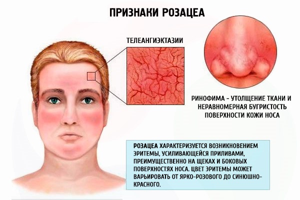 Себорейный дерматит на лице. Фото, причины и лечение народными средствами, мази и кремы, препараты, лечебные шампуни