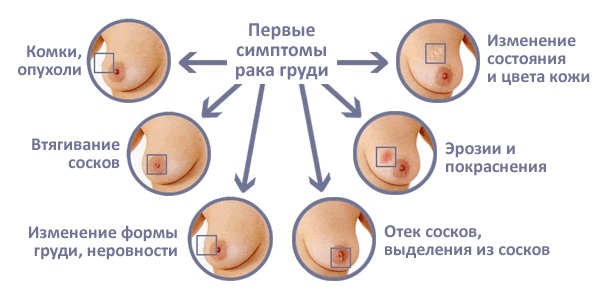 УЗИ молочных желез - когда можно делать, расшифровка, норма, подготовка, на какой день цикла