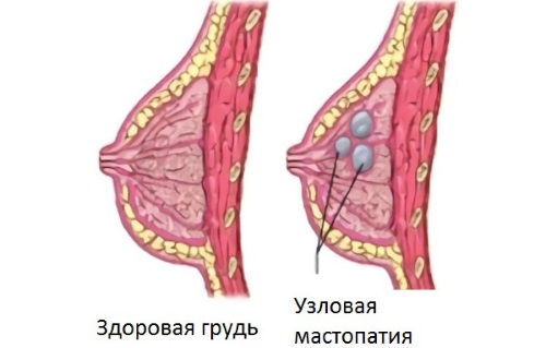 УЗИ молочных желез - когда можно делать, расшифровка, норма, подготовка, на какой день цикла