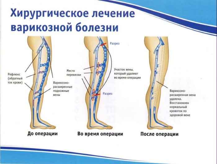 Варикозное расширение вен на ногах: что это такое, симптомы и лечение, фото