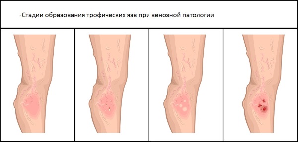 Варикозное расширение вен на ногах: что это такое, симптомы и лечение, фото