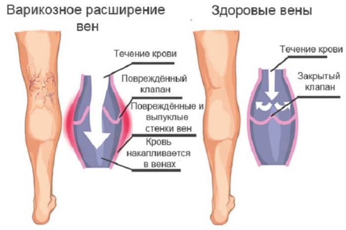 Варикозное расширение вен на ногах: что это такое, симптомы и лечение, фото