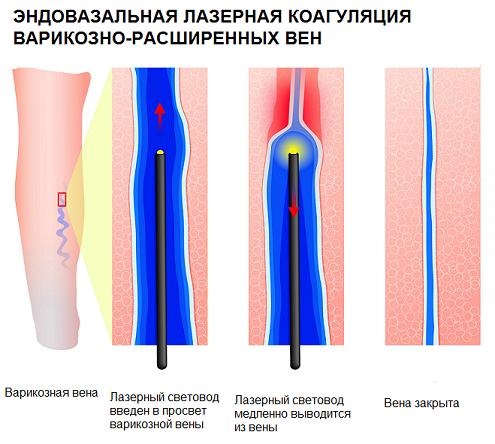 Варикозное расширение вен на ногах: что это такое, симптомы и лечение, фото