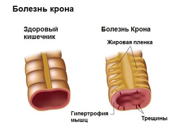 Вазелиновое масло - применение при запорах у детей и взрослых. Как принимать, дозировка