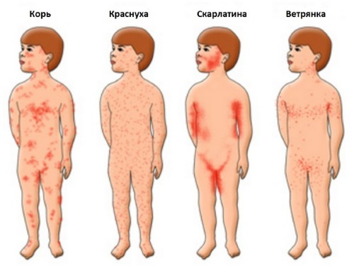 Высыпание на коже у ребенка, красные пятна, крапивница, прыщики с зудом. Причины и лечение в домашних условиях