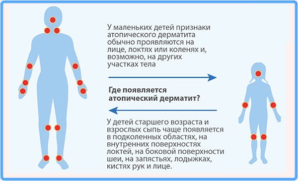 Высыпание на коже у ребенка, красные пятна, крапивница, прыщики с зудом. Причины и лечение в домашних условиях