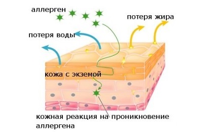 Высыпания на коже при аллергии на лице, руках, ногах, теле у ребенка и взрослого. Фото. Лечение в домашних условиях