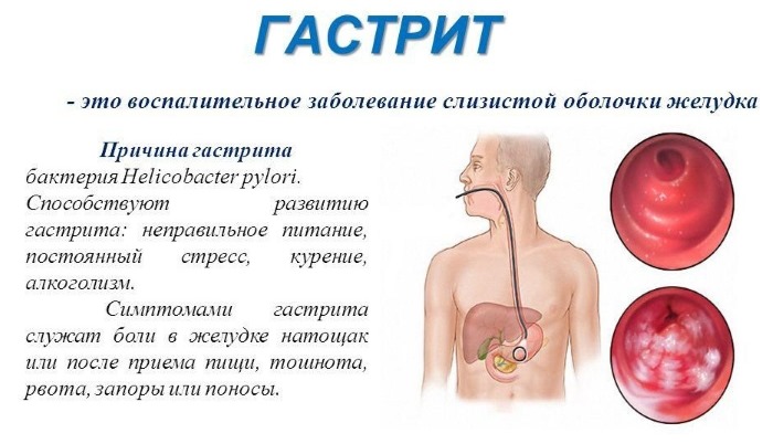 Вздутие живота и газообразование - причины и лечение: лекарства, народные средства, диета, рекомендуемые продукты