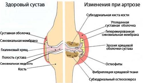 Артроз коленного сустава: симптомы и лечение народными средствами, физическими упражнениями, препараты из аптеки