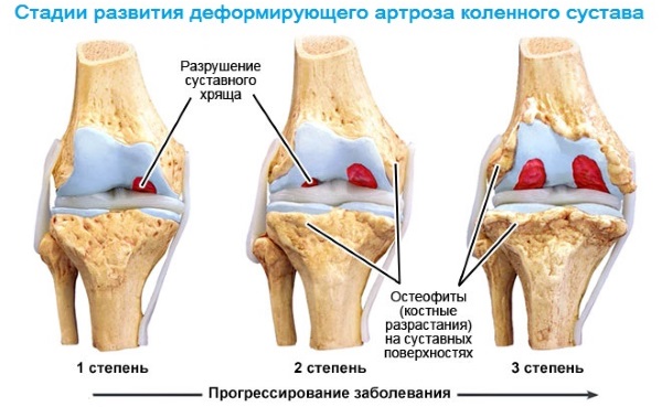 Артроз коленного сустава: симптомы и лечение народными средствами, физическими упражнениями, препараты из аптеки