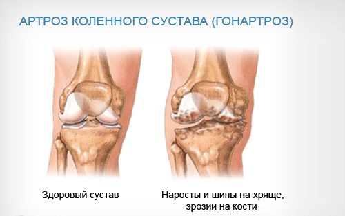 Артроз коленного сустава: симптомы и лечение народными средствами, физическими упражнениями, препараты из аптеки