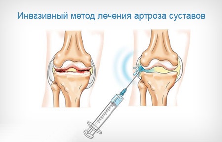 Артроз коленного сустава: симптомы и лечение народными средствами, физическими упражнениями, препараты из аптеки