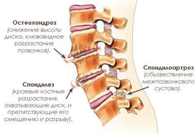 Боль в пояснице. Причины у женщин и мужчин при сидении, после родов, по утрам. Ноющая, тянущая, постоянная, опоясывающая, ночная, больно наклоняться. Лечение