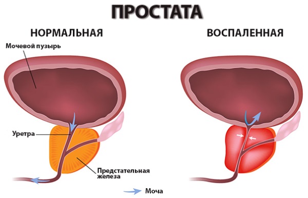 Боль в пояснице. Причины у женщин и мужчин при сидении, после родов, по утрам. Ноющая, тянущая, постоянная, опоясывающая, ночная, больно наклоняться. Лечение