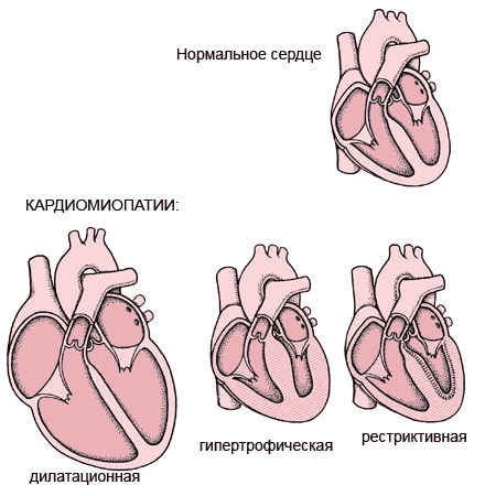 Причины боли в сердце у женщин. Симптомы и лечение. Что делать, к какому врачу обратиться, что принимать