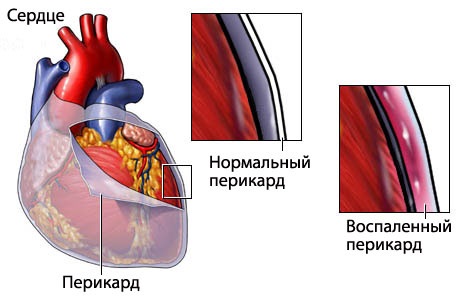 Причины боли в сердце у женщин. Симптомы и лечение. Что делать, к какому врачу обратиться, что принимать