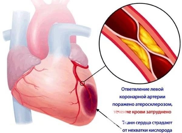 Причины боли в сердце у женщин. Симптомы и лечение. Что делать, к какому врачу обратиться, что принимать