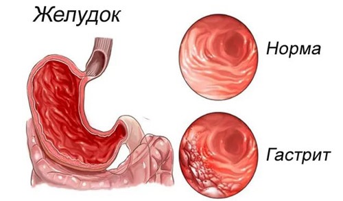 Настойка Эхинацеи. Инструкция по применению для детей и взрослых. Аналоги, цена, отзывы