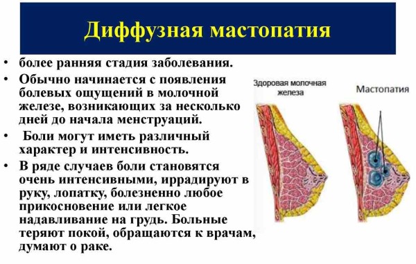 Фиброзно-кистозная мастопатия молочной железы. Что это такое, как лечить, чем опасна при беременности. Признаки, симптомы, фото