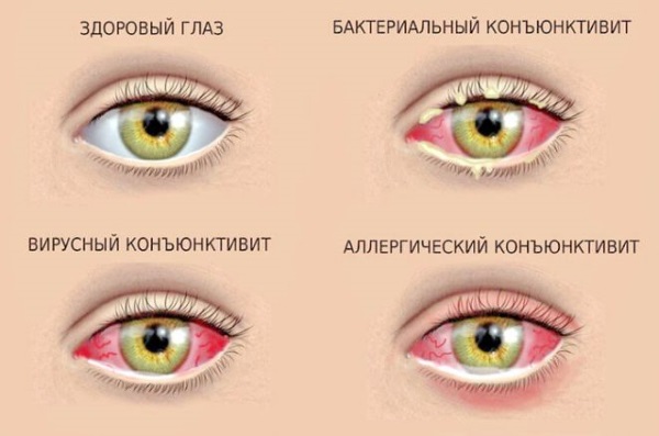 Глазные капли с гиалуроновой кислотой без консервантов. Список названий, инструкция по применению, цены