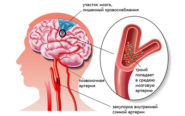 Головокружение: причины у женщин при нормальном давлении, смене положения, климаксе, в иных случаях. Способы лечения