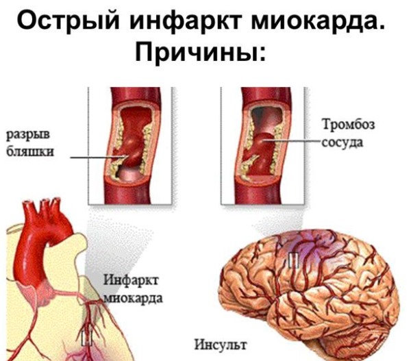 Густая кровь: причины и лечение у женщин, при беременности, мужчин, новорожденного ребенка. Симптомы, чем опасна, как разжижать, диета