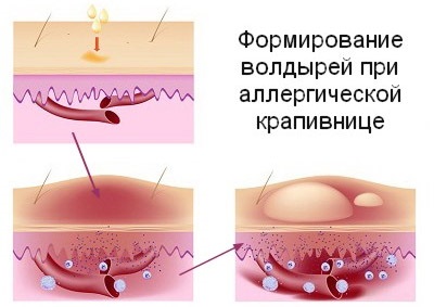 Крапивница: фото, симптомы и лечение у взрослых, детей. Как выглядит аллергическая, идиопатическая, острая, хроническая, холодовая. Препараты, диета, мази