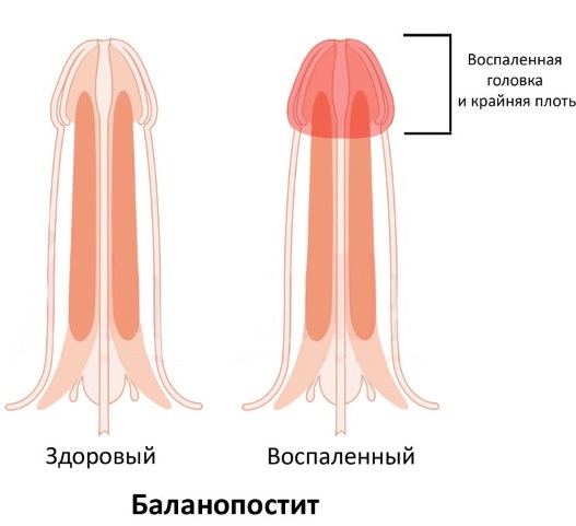 Левомеколь мазь. Инструкция по применению, состав, свойства, аналоги, цена, отзывы