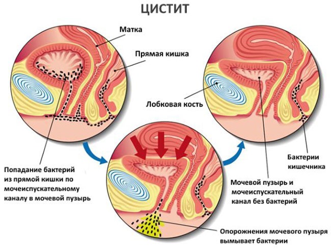 Мочевой пузырь: воспаление у женщин, мужчин, лечение, симптомы. Как лечить медикаментами, антибиотиками, таблетки при беременности, травами, народные средства