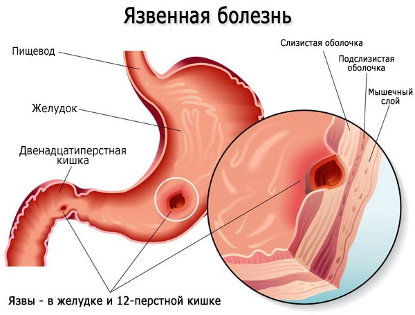 Омепразол. Инструкция по применению, цена, отзывы, аналоги