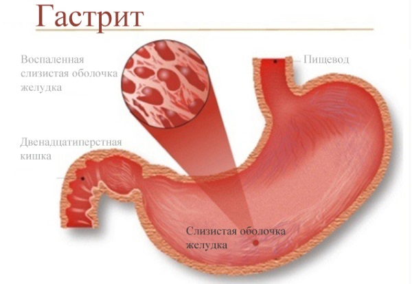 Омепразол. Инструкция по применению, цена, отзывы, аналоги