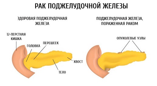 Поджелудочная железа. Симптомы и лечение заболевания у взрослых и детей. Диета