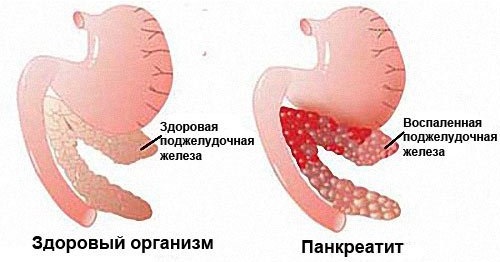 Поджелудочная железа. Симптомы и лечение заболевания у взрослых и детей. Диета