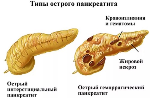 Поджелудочная железа. Симптомы и лечение заболевания у взрослых и детей. Диета