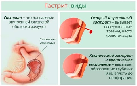 Средство от тошноты для детей, взрослых, при отравлении, похмелье, беременности, месячных, инфекции, народные методы в домашних условиях