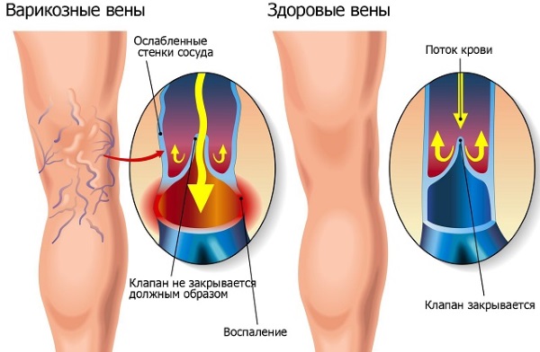 Тонкая кожа и выступающие вены: причины у парней, девушек. Почему видны, вздуваются. Уход за тонкой кожей  лица и тела