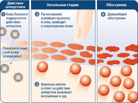 Атопический дерматит фото лечение мази и кремы название у детей