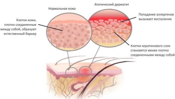Атопический дерматит у ребенка: причины, как и чем лечить при обострении, на лице, щеках, попе, голове, ногах, руках. Лечение народными средствами, диета, меню