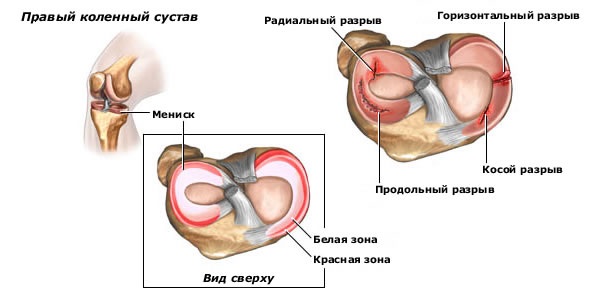 Боль в колене сбоку с внутренней стороны, внешней, наружной, от и до бедра. Причины и лечение. К какому врачу обратиться