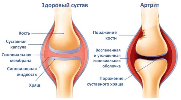 Боль в колене сбоку с внутренней стороны, внешней, наружной, от и до бедра. Причины и лечение. К какому врачу обратиться