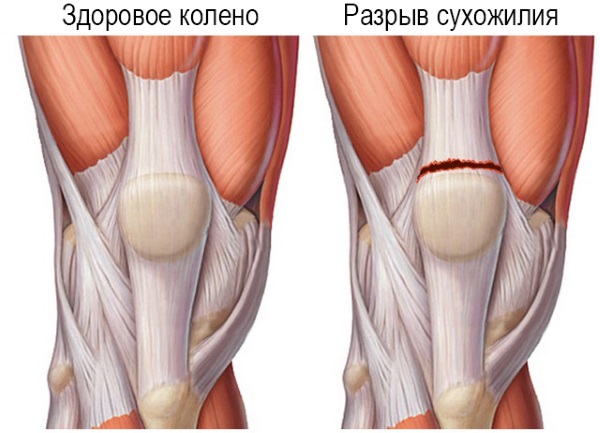 Боль в колене сбоку с внутренней стороны, внешней, наружной, от и до бедра. Причины и лечение. К какому врачу обратиться