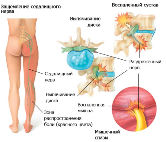 Боль в колене сбоку с внутренней стороны, внешней, наружной, от и до бедра. Причины и лечение. К какому врачу обратиться