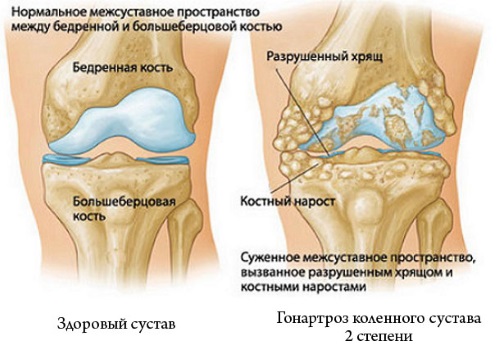 Боль в колене сбоку с внутренней стороны, внешней, наружной, от и до бедра. Причины и лечение. К какому врачу обратиться