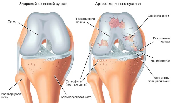 Боль в колене сбоку с внутренней стороны, внешней, наружной, от и до бедра. Причины и лечение. К какому врачу обратиться