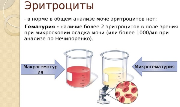 Эритроциты в моче - что это значит, норма у взрослого, ребенка. Таблица. Причины гематурии (повышенных показателей) у мужчин, женщин, при беременности