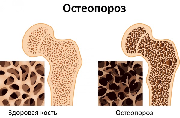 Женские гормоны эстрогены - что это такое, их функции. Симптомы недостатка, избытка, как повысить, снизить уровень, диагностика