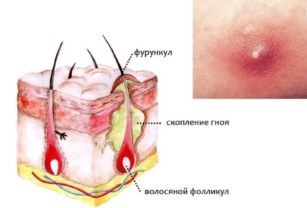 Фурункулёз. Причины и лечение у взрослых, подростков, детей. Препараты антибиотики, диета, народные средства