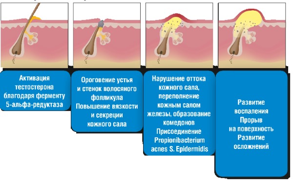 Фурункулёз. Причины и лечение у взрослых, подростков, детей. Препараты антибиотики, диета, народные средства