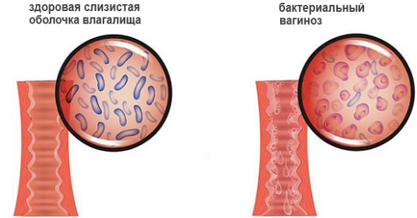Гарднерелла у женщин. Симптомы и лечение гарднереллеза, причины возникновения, норма. Чем лечить: народные средства, свечи, антибиотики